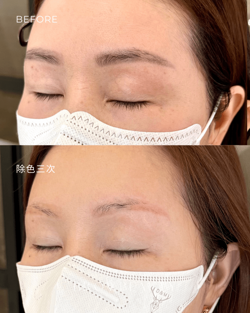 桃園無創除色，眉毛淡色