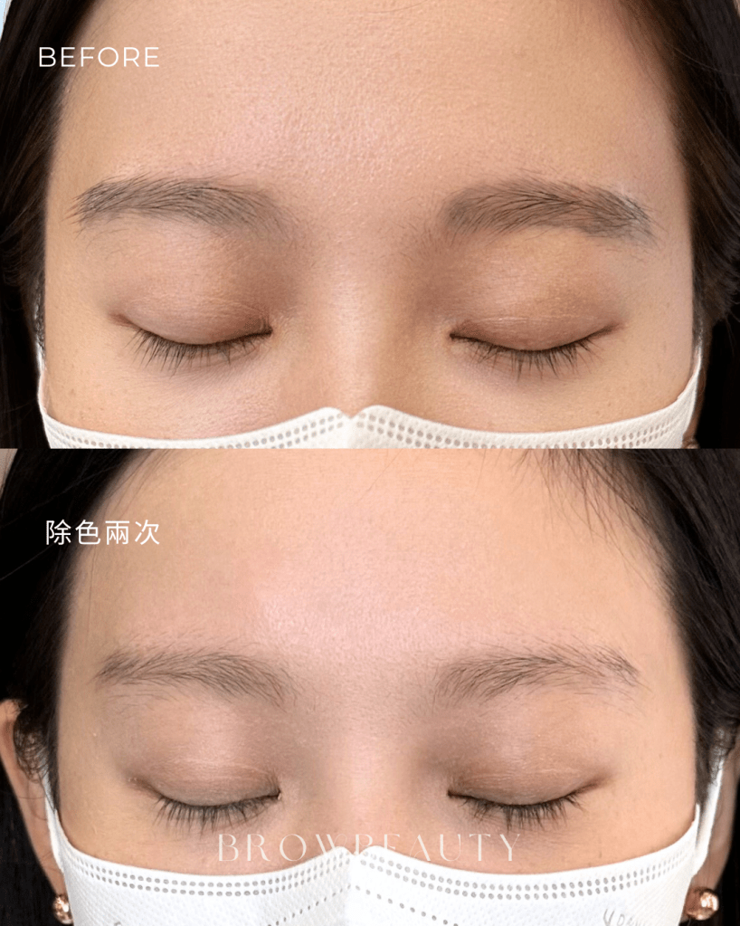 桃園除色，無創除色前後對比