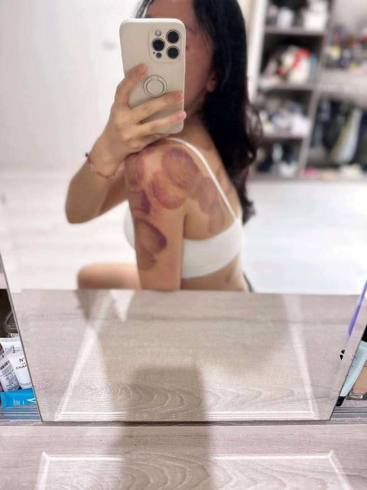 每個月的整骨/拔罐是必須