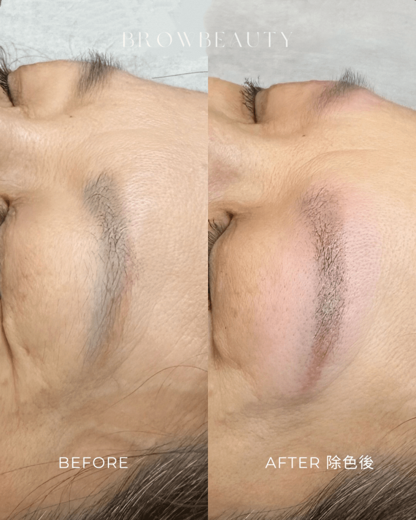 眉尾出現常見的雙眉尾殘色,雖然顏色淡但佔面積大,視覺偏粗,底妝難完全遮蓋。透過一次眉毛除色,藍灰霧眉底色明顯改善,眉尾變得更乾淨,適合後續重新設計眉型與上色。