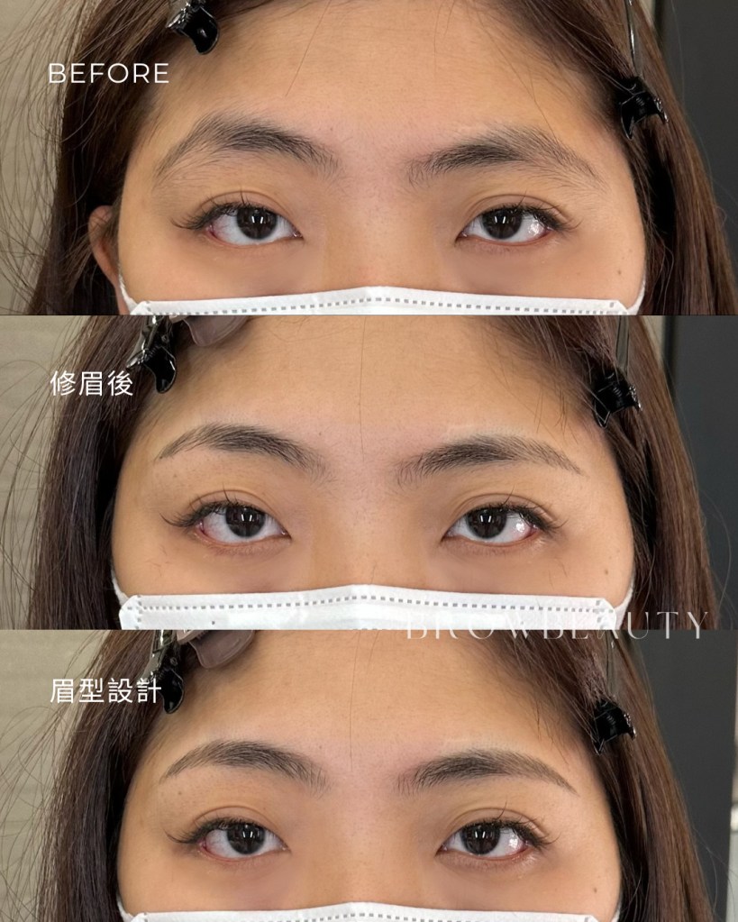 女生高低眉修眉案例,原本因長期挑眉習慣,一側眉毛弧度較高,放大左右高低差。透過修眉收斂挑眉側弧度,在不畫眉的前提下,讓兩邊眉型視覺更平衡自然。